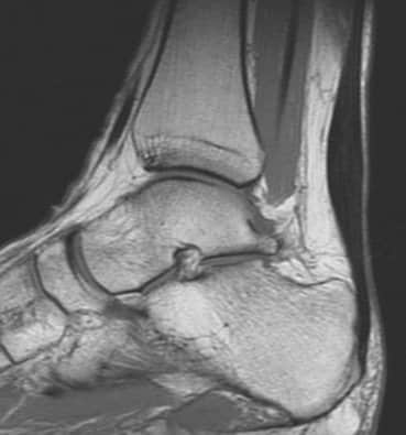 Achilles Tendinopathy Treatment