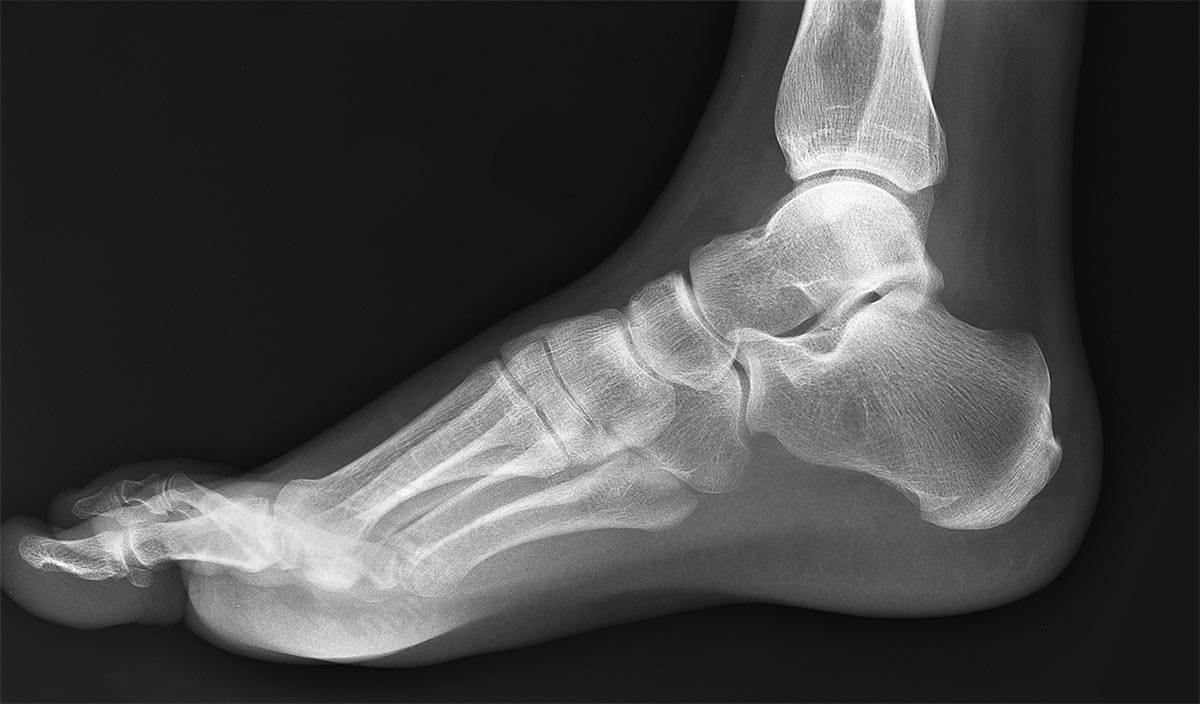 running with plantar fasciitis - x-ray